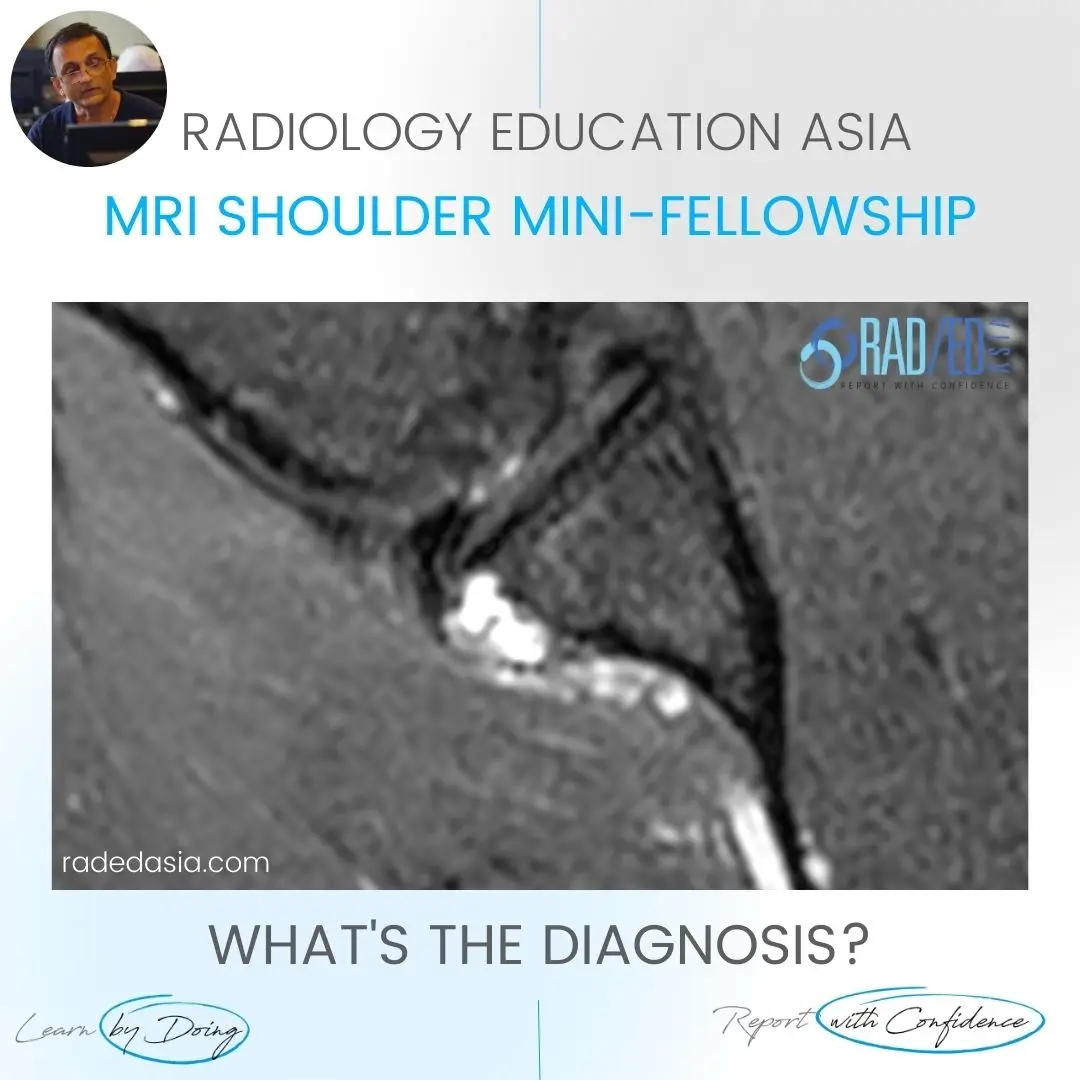 shoulder-labrum-paralabral-cyst-labrum-mri-radedasia.jpg