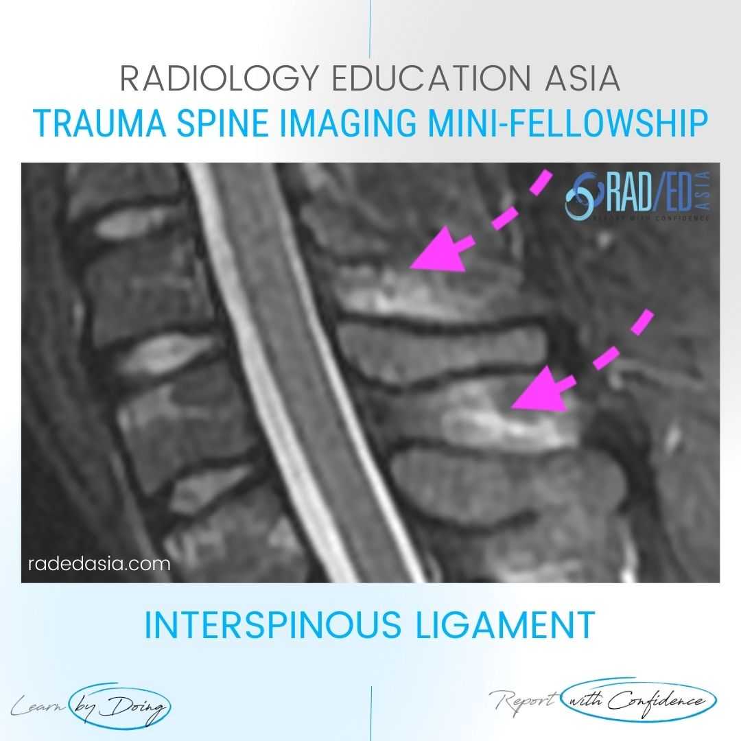 spine-ligaments-mri-injury-radiology-interspinous-trauma-radedasia.jpg