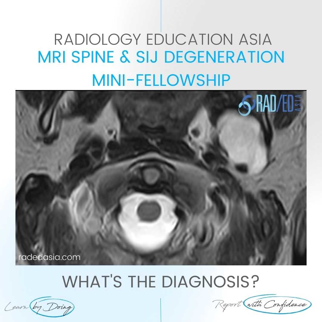 spine-mri-incidental-findings-parotid-mass.jpg