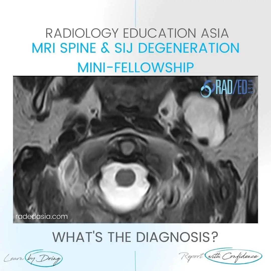 spine-mri-incidental-findings-parotid-mass.jpg