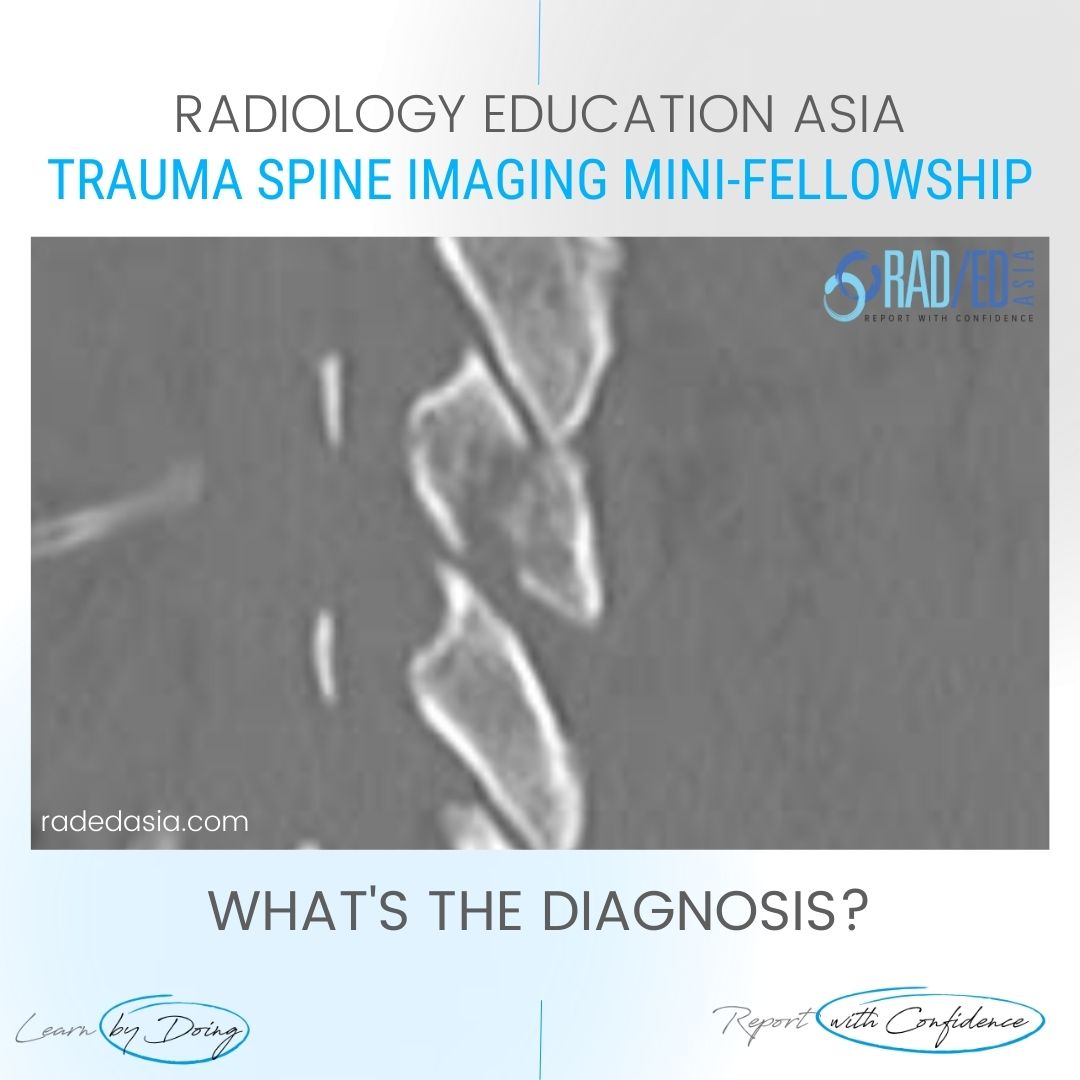 spine-trauma-imaging-facet-fracture-dislocation-radiology-ct.jpg