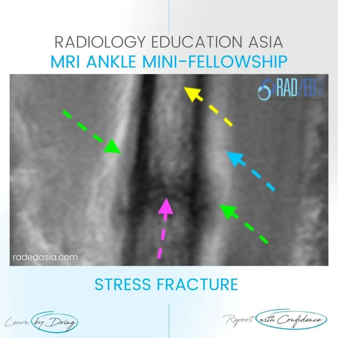 stress-fracture-fibula-shin-mri-radiology-periosteal-xray-radedasia.jpg