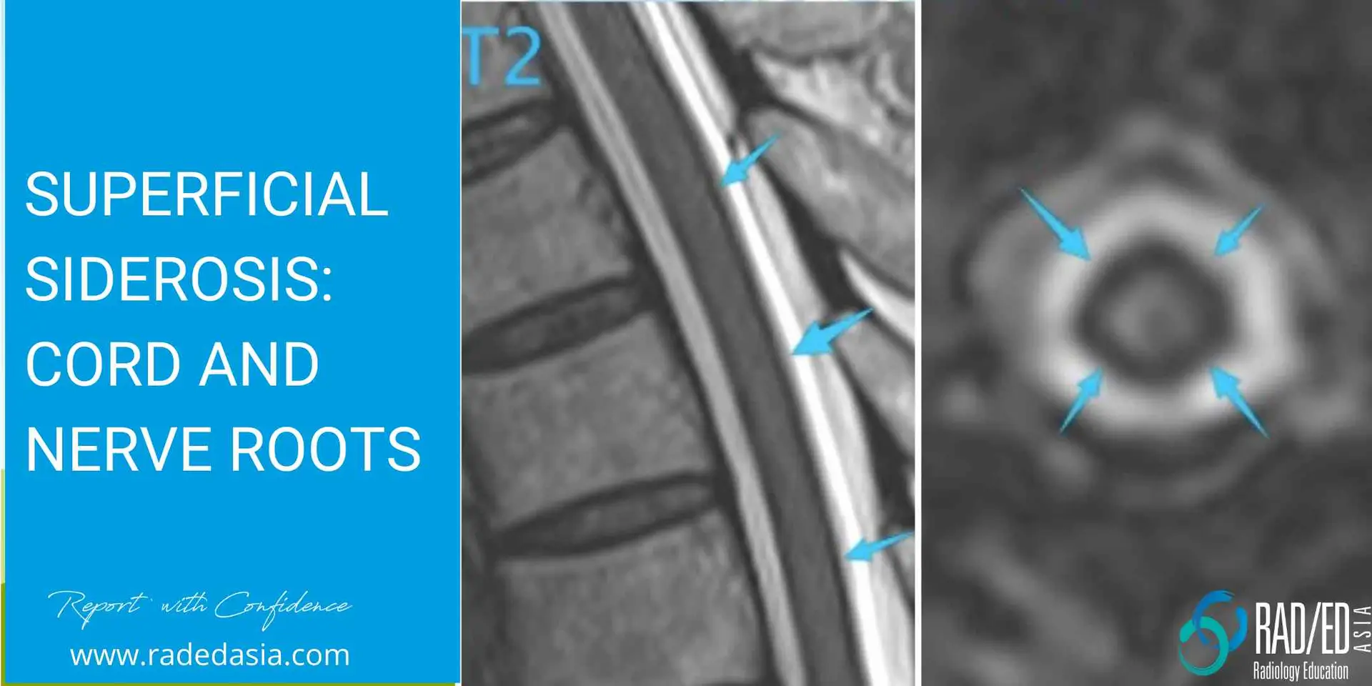 superficial siderosis mri cord spine radedasia