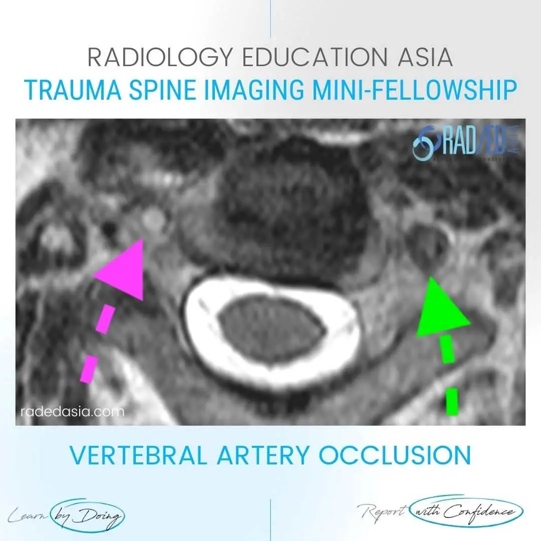 vertebral-artery-dissection-mri-radiology-diagnosis.jpg