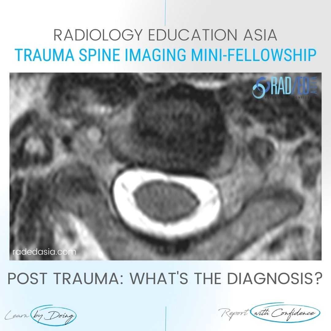 vertebral-artery-dissection-radiology-mri-diagnosis.jpg