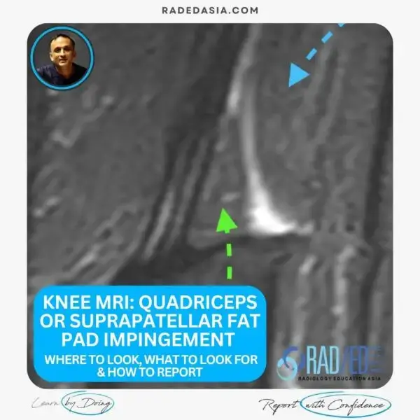 knee mri quadriceps or suprapatellar fat pad impingement radiology