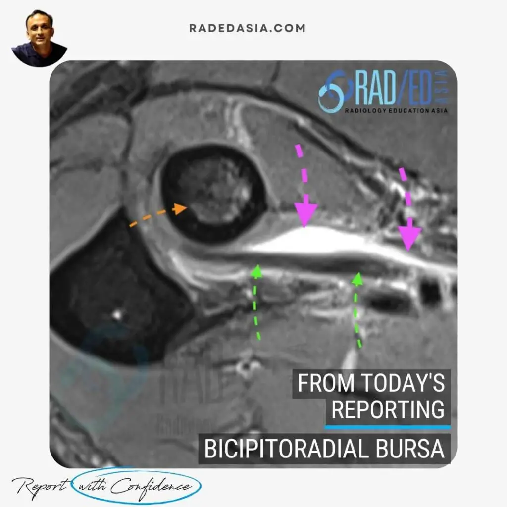 MRI of an enlarged bicipitoradial bursa showing inflammation between the biceps tendon and radial head, best visualized on T2FS and PDFS