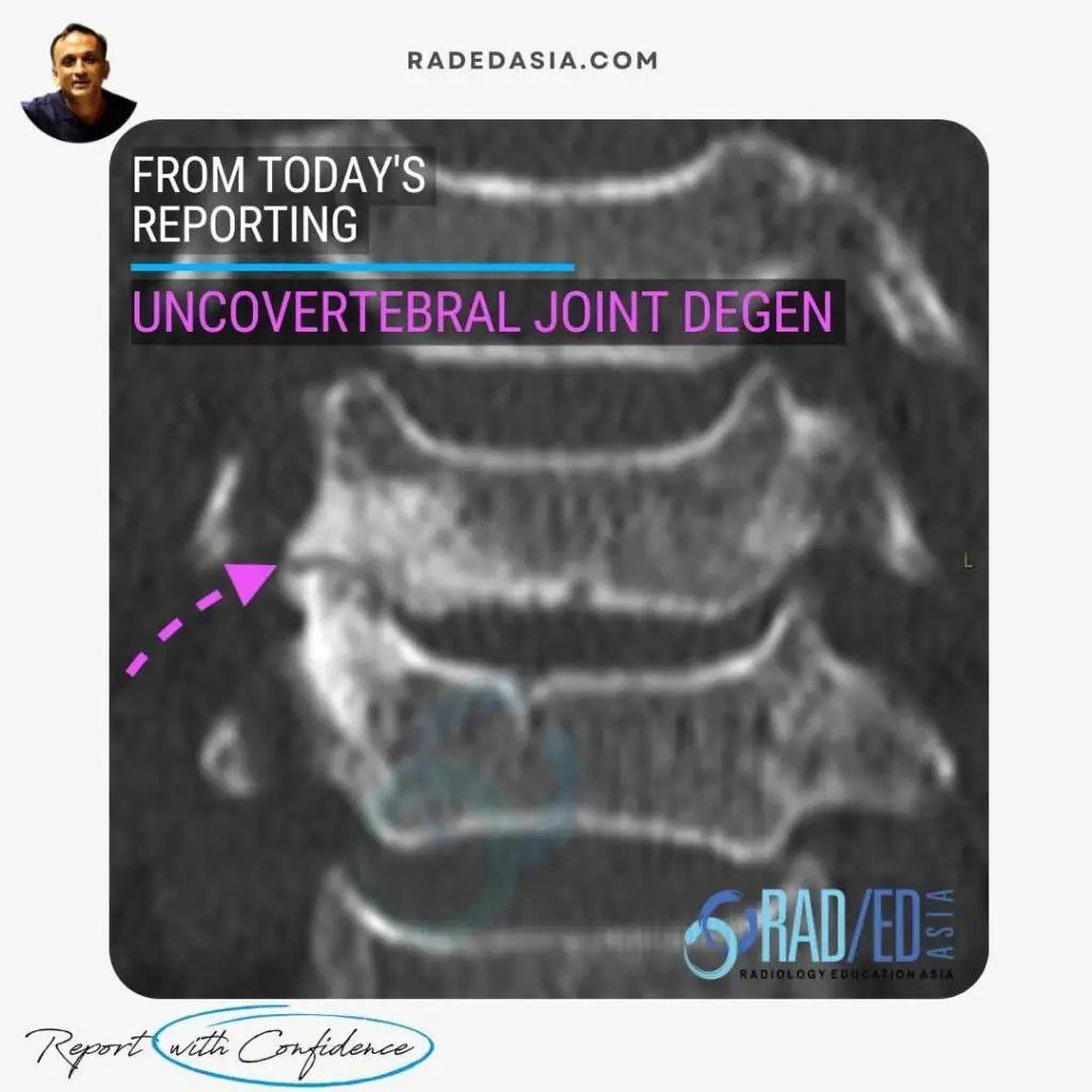 CT scan of the cervical spine showing uncovertebral joint degeneration with sclerosis and loss of joint space coronal reformat