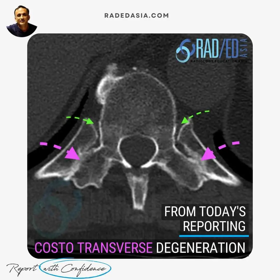 CT scan showing costotransverse joint degeneration with loss of joint space, subcortical sclerosis and cortical irregularity