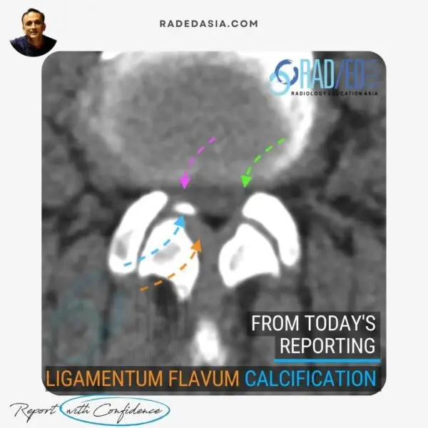 Axial CT image of the lumbar spine at the L4-L5 level showing focal calcification of the ligamentum flavum. Note both soft tissue thickening of the ligament flavum and the more dense calcification both contributing to right sided subarticular/lateral recess stenosis.