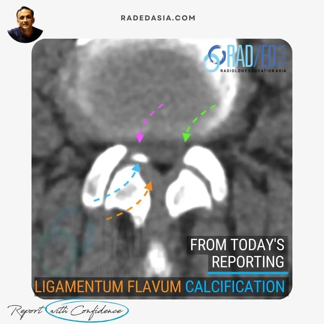 Axial CT image of the lumbar spine at the L4-L5 level showing focal calcification of the ligamentum flavum. Note both soft tissue thickening of the ligament flavum and the more dense calcification both contributing to right sided subarticular/lateral recess stenosis.