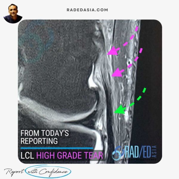 Coronal PDFS MRI of the knee demonstrating a high-grade lateral collateral ligament (LCL) tear of the knee with increased signal and fiber disruption. Note the comparison to the normal distal LCL