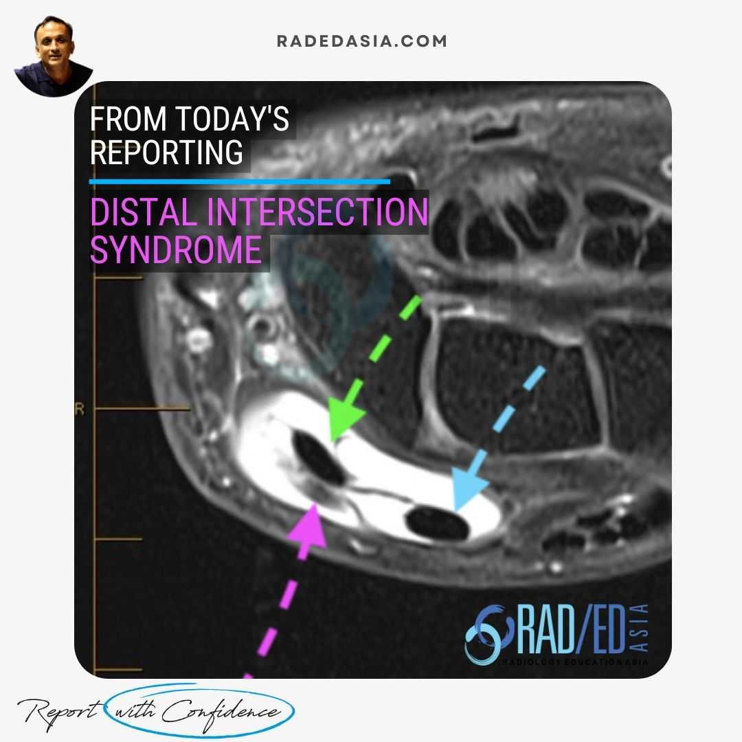 MRI scan of the wrist showing distal intersection syndrome with tenosynovitis distal to Lister’s tubercle, demonstrating significant tenosynovitis involving compartment 2 and 3 tendons.