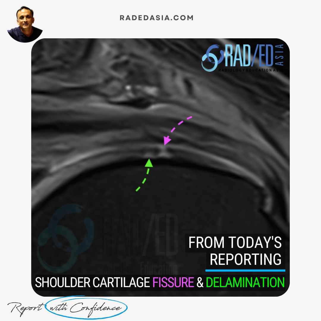 MRI coronal view of the shoulder showing a cartilage fissure with delamination in the glenohumeral joint