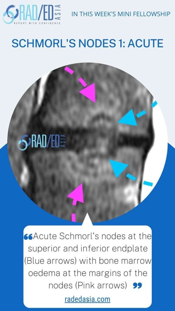 MRI image of acute Schmorl’s node in the spine showing peripheral bone marrow edema.
