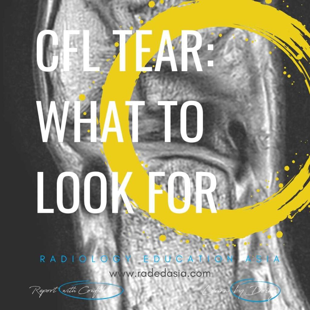 MRI of an ankle showing a tear in the calcaneofibular ligament (CFL), a key lateral ankle ligament.