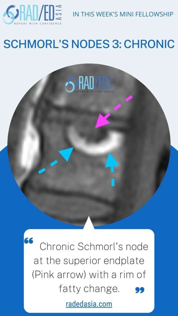 MRI showing chronic Schmorl’s node in the spine with reactive fatty marrow infiltration.