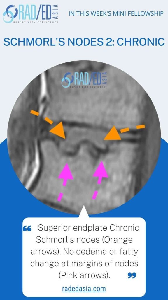 Chronic Schmorl’s node on spine MRI with corticated margins and no edema or fat infiltration.