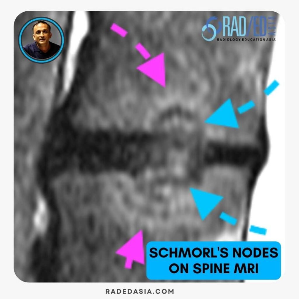 MRI of the lumbar spine showing an acute Schmorl's node with characteristic vertebral body changes.
