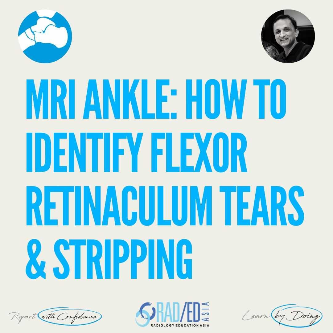 MRI image showing deltoid ligament tear and associated flexor retinaculum injury.