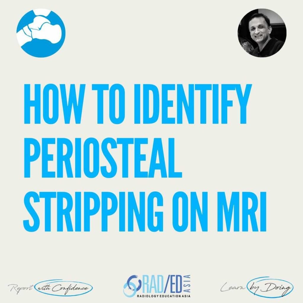 MRI periosteal stripping double black line cortex periosteum ankle shoulder trauma