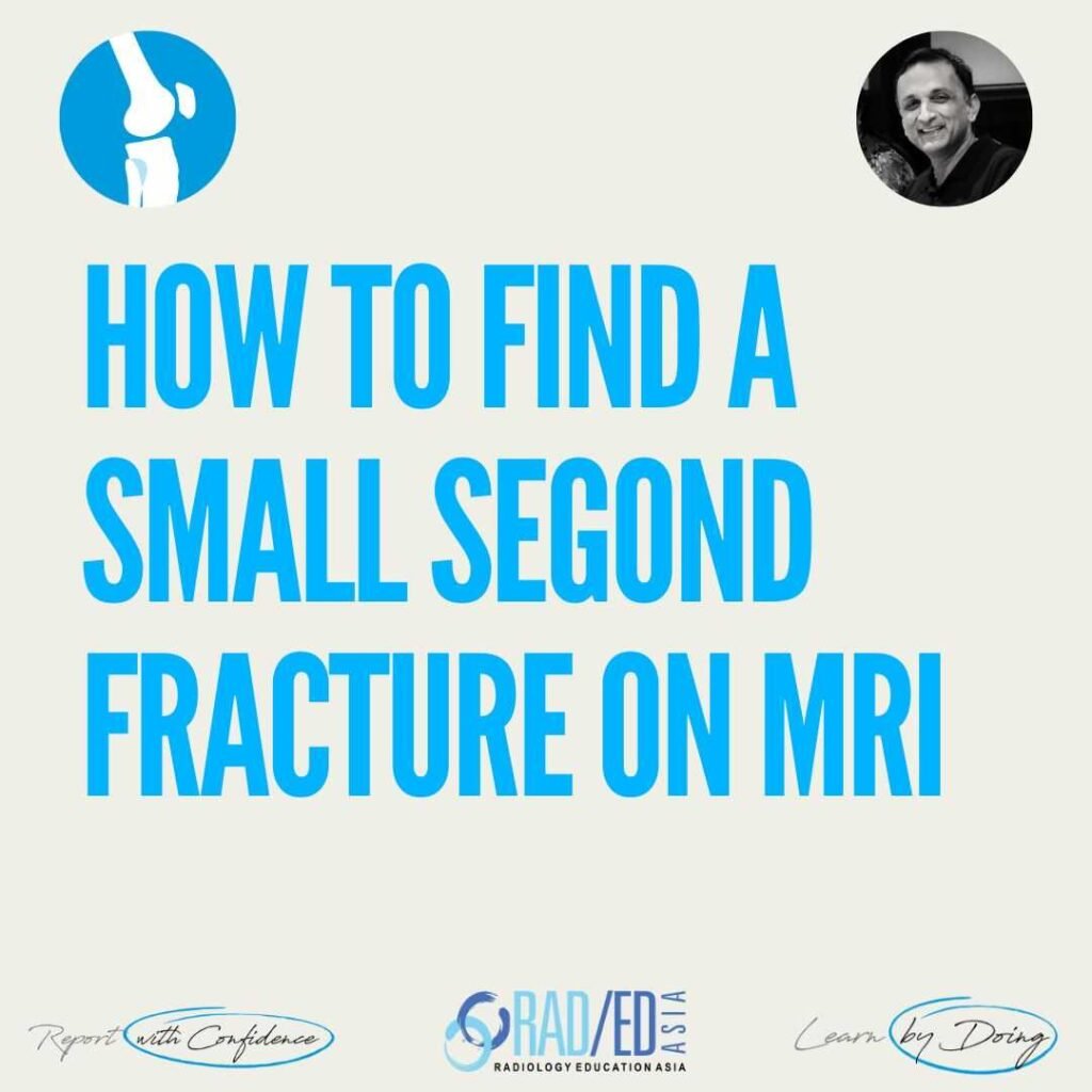 How to find small avulsion segond fracture on MRI