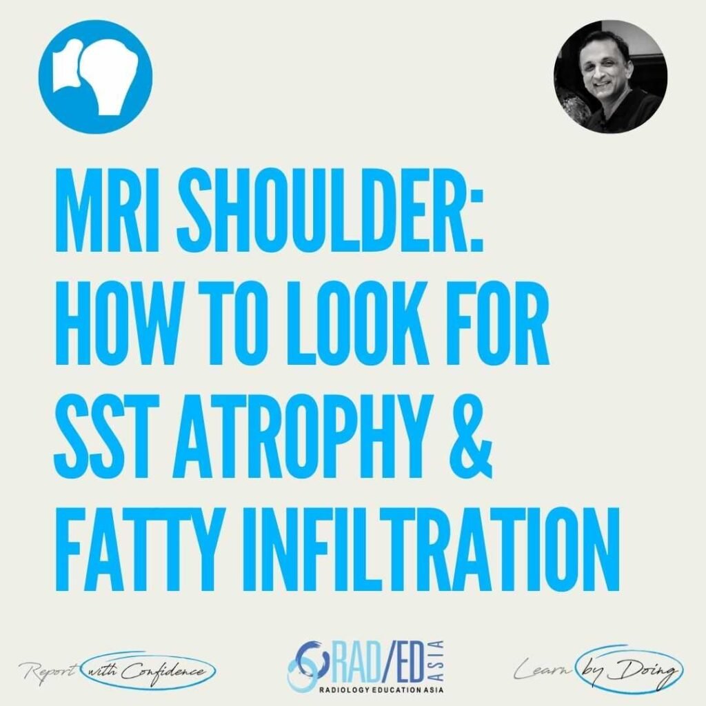MRI shoulder showing supraspinatus muscle atrophy and fatty infiltration.