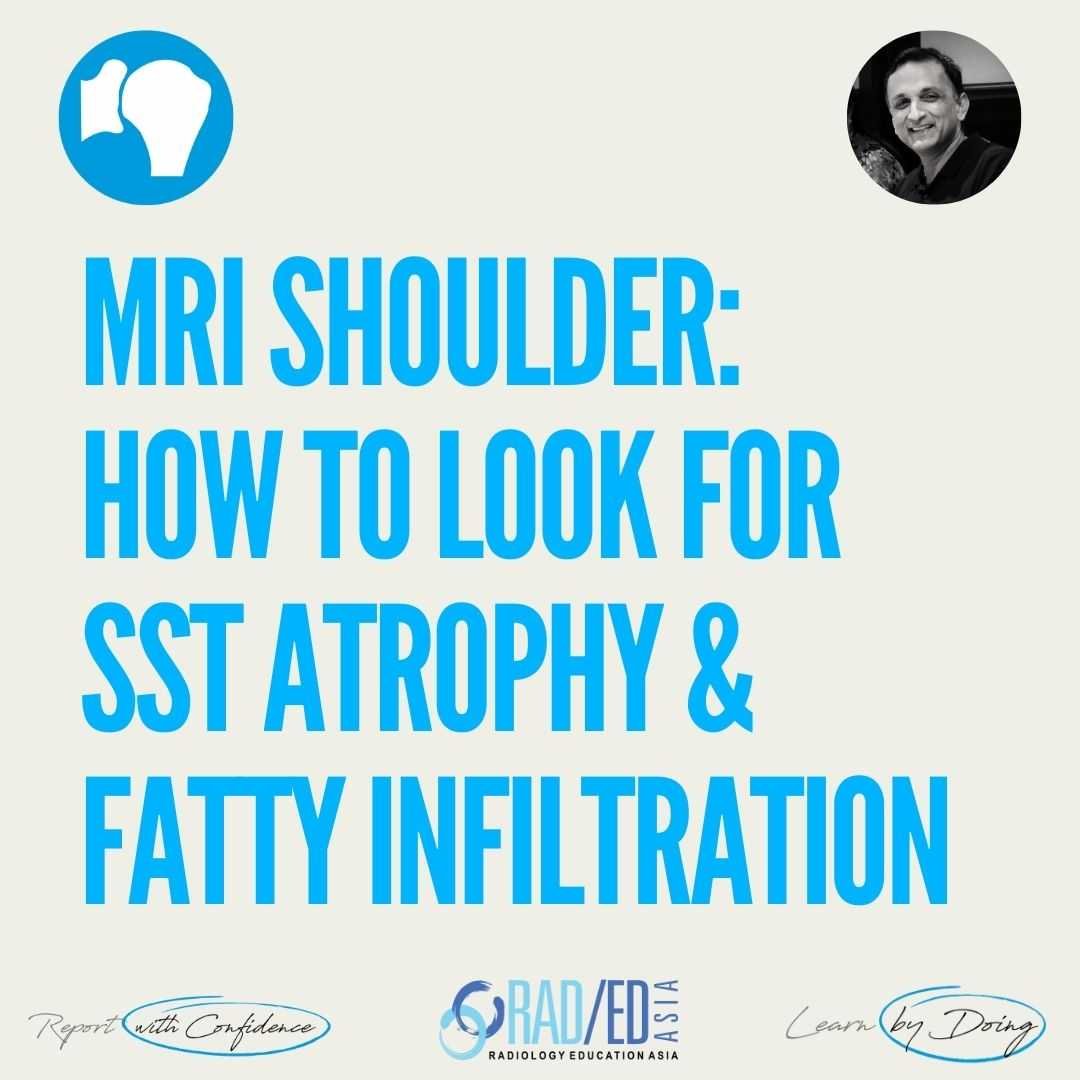 MRI shoulder showing supraspinatus muscle atrophy and fatty infiltration.