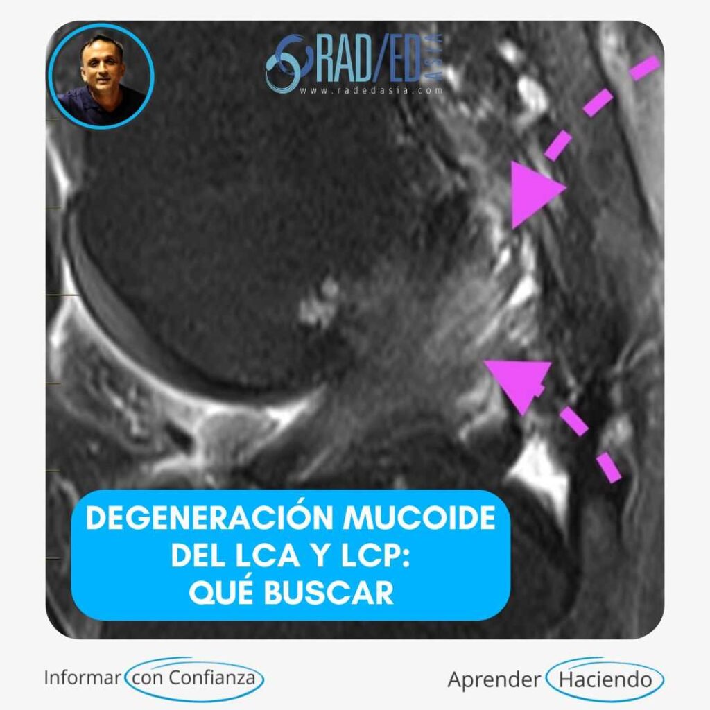 acl-pcl-mucoid-degeneracion-mri-hallazgos-radedasia
