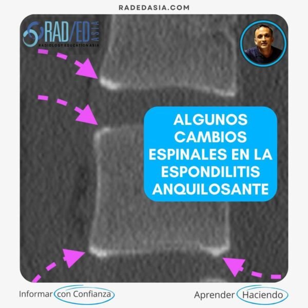 espondilitis anquilosante columna vertebral radiología ct