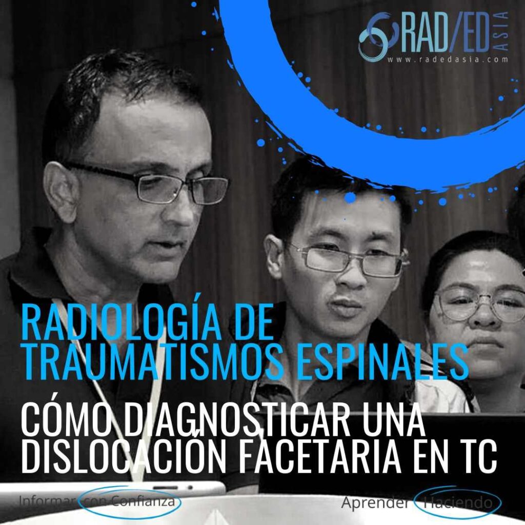 columna vertebral trauma radiología luxación facetaria subluxación perched locked ct imaging radedasia