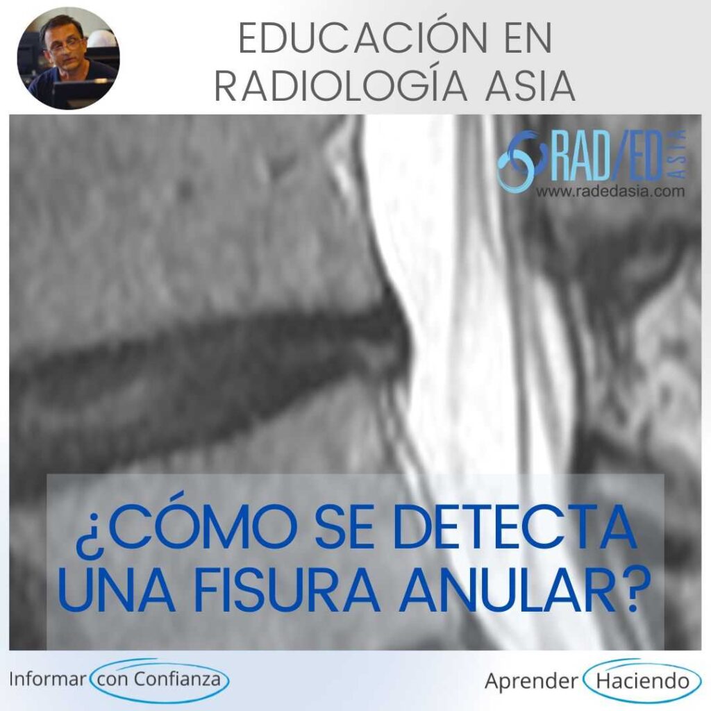 desgarro fisura anular radiología resonancia magnética columna lumbar radedasia