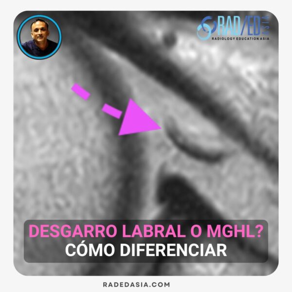 Resonancia magnética axial del hombro que muestra el ligamento glenohumeral medio (MGHL) anterior al labrum.