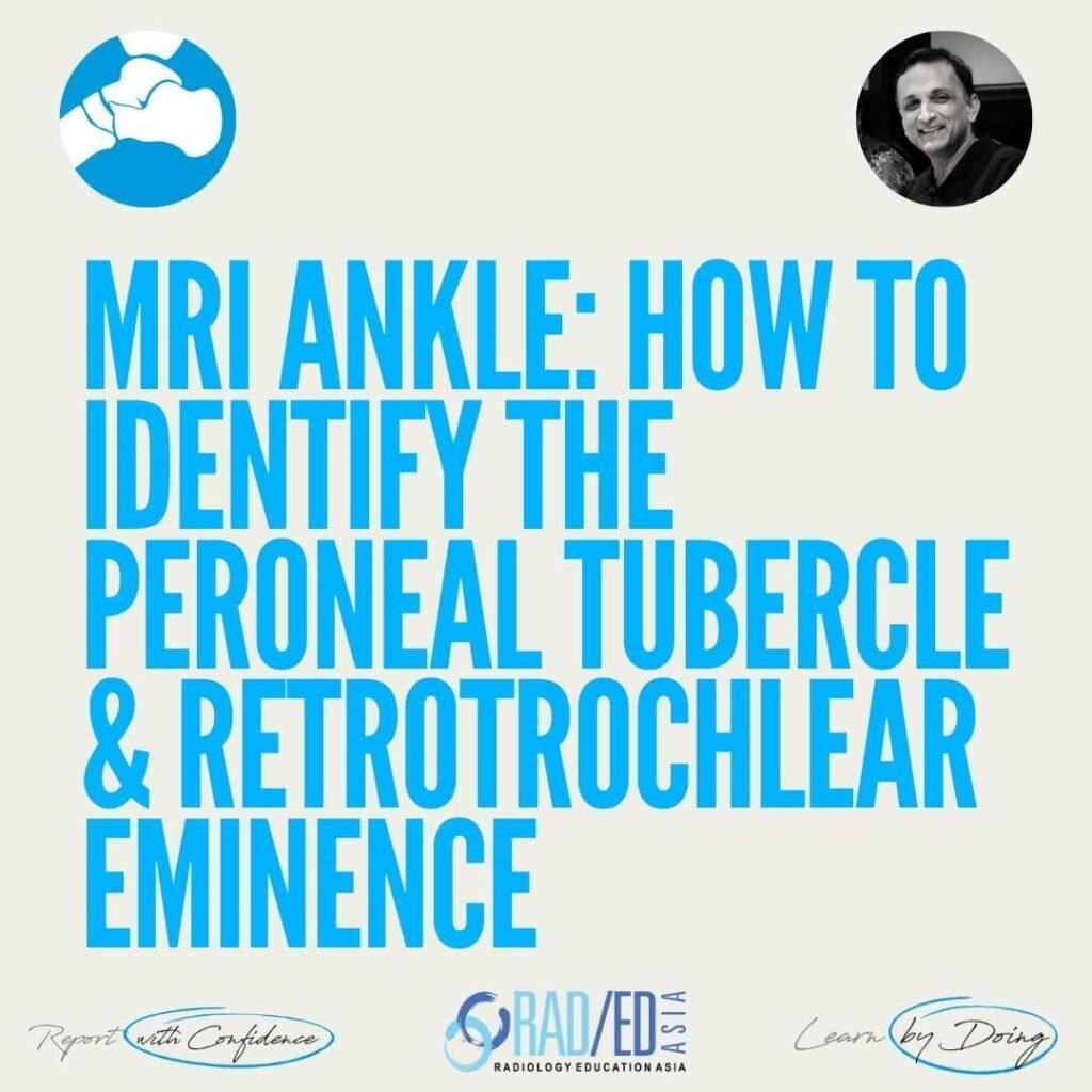 MRI Ankle: How to Identify the Peroneal Tubercle and Retrotrochlear Eminence