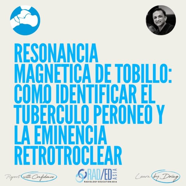 Resonancia magnética del tobillo: Cómo identificar el tubérculo peroneo y la eminencia retrotroclear