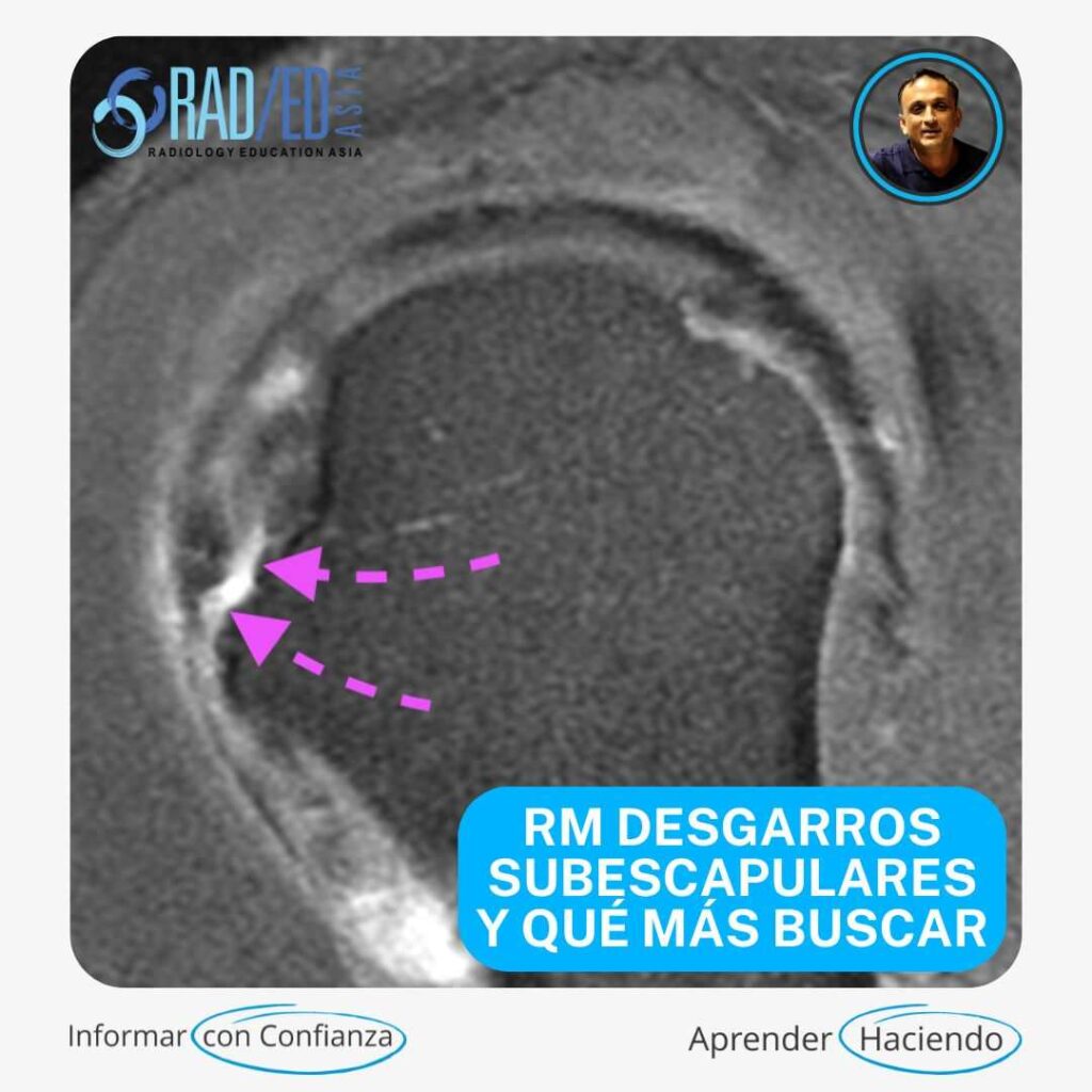 DESGARRO SUBESCAPULAR ATROFIA INFILTRACIÓN GRASA DISLOCACIÓN DEL BÍCEPS