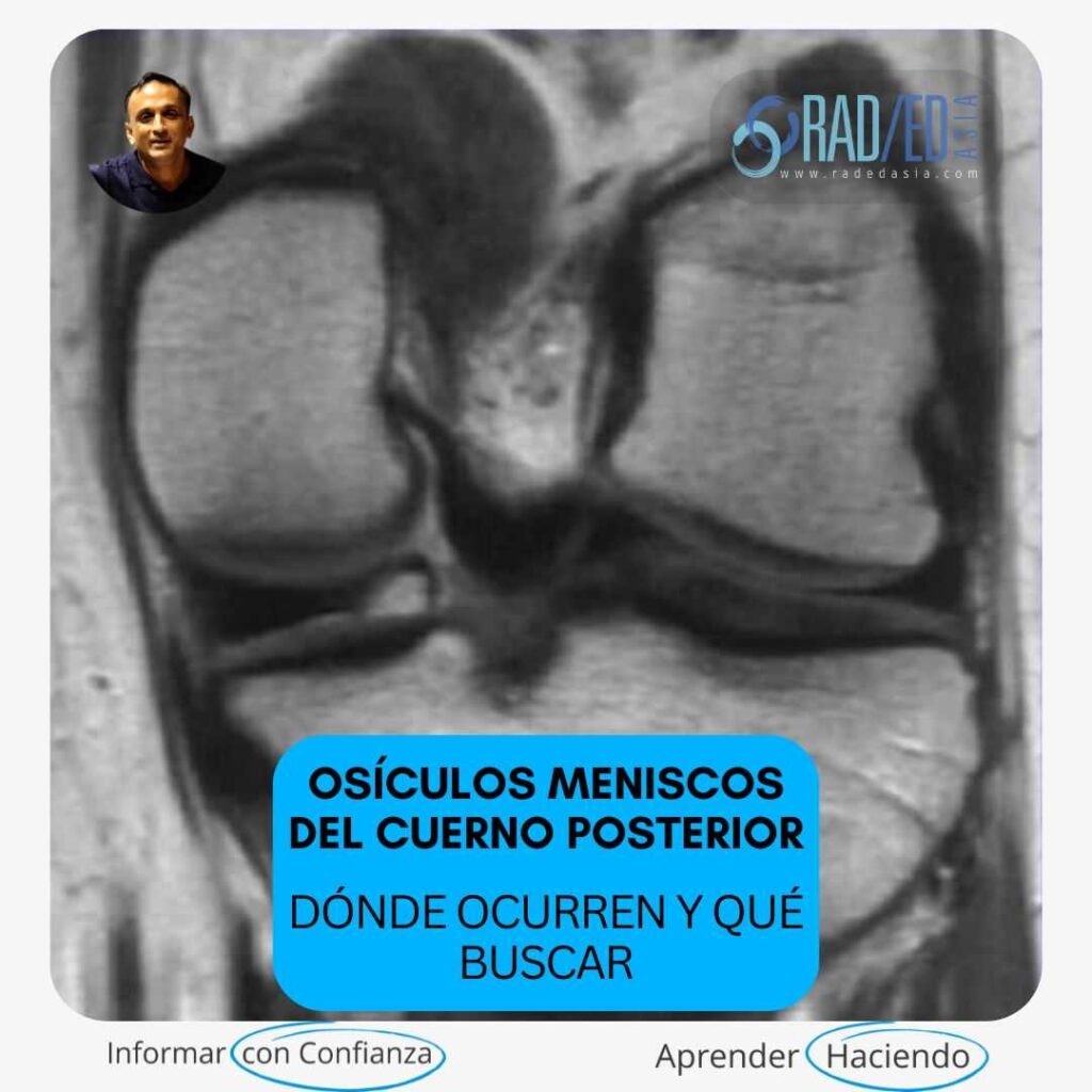 meniscal-ossicles-posterior-horn-meniscus-knee-mri-radedasia