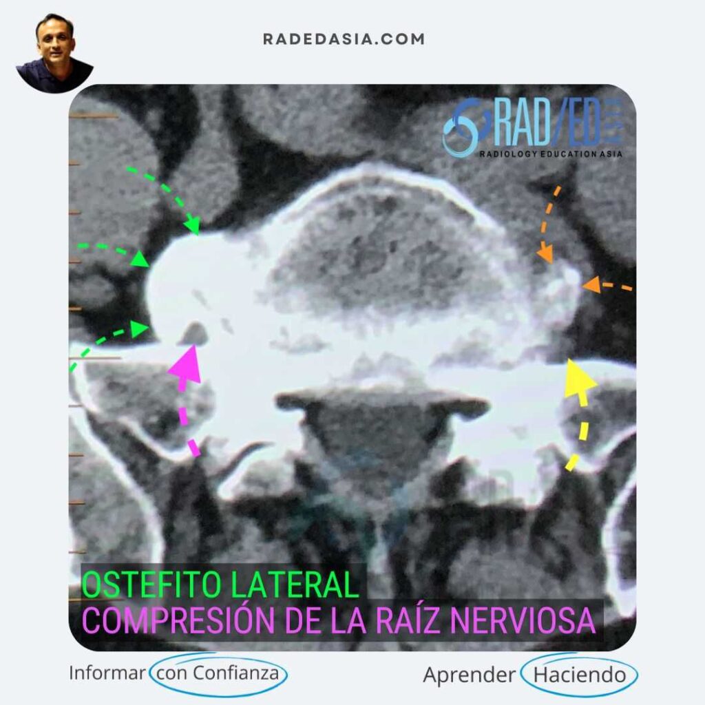 Vista axial por TC de la columna lumbar, que muestra un osteofito lateral que comprime la raíz nerviosa saliente en el espacio lateral lejano.