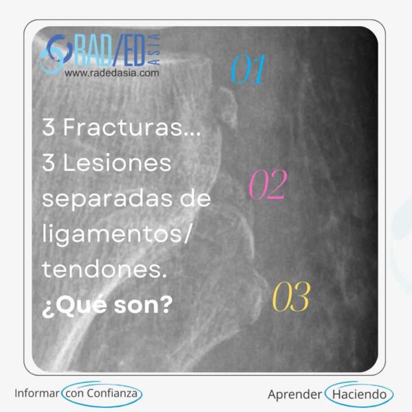radiologia rodilla segond arcuate lateral fibular fracture xray mri rodilla radedasia