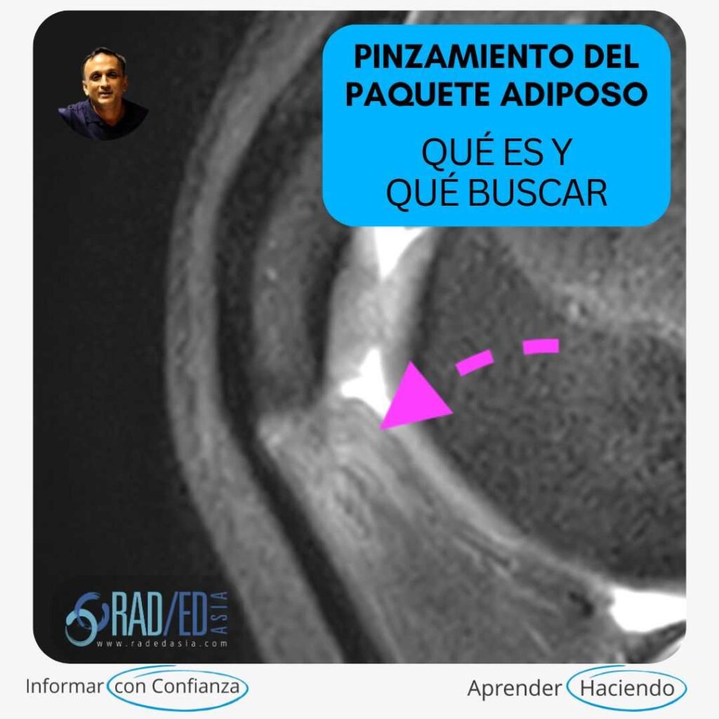 Resonancia magnética sagital PDFS de la rodilla que muestra el pinzamiento de la almohadilla grasa de Hoffa (infrapatelar).