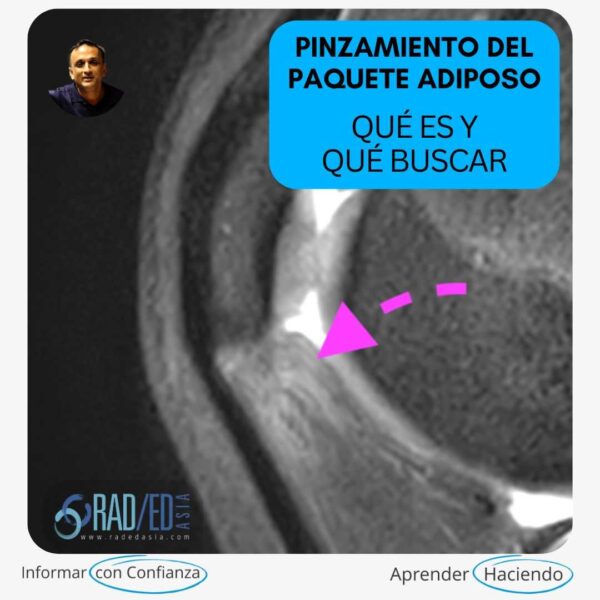 Resonancia magnética sagital PDFS de la rodilla que muestra el pinzamiento de la almohadilla grasa de Hoffa (infrapatelar).