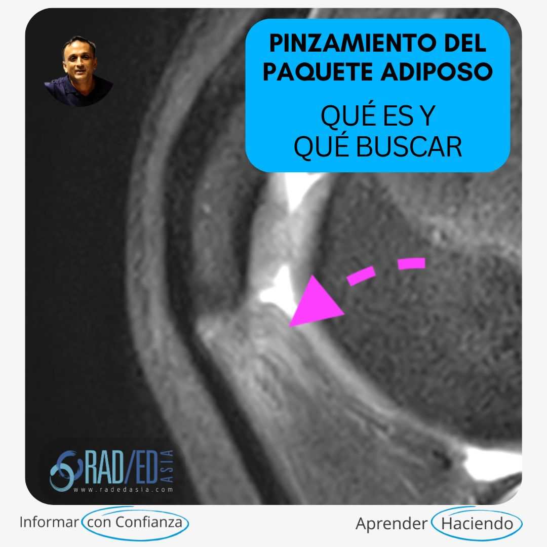 Resonancia magnética sagital PDFS de la rodilla que muestra el pinzamiento de la almohadilla grasa de Hoffa (infrapatelar).