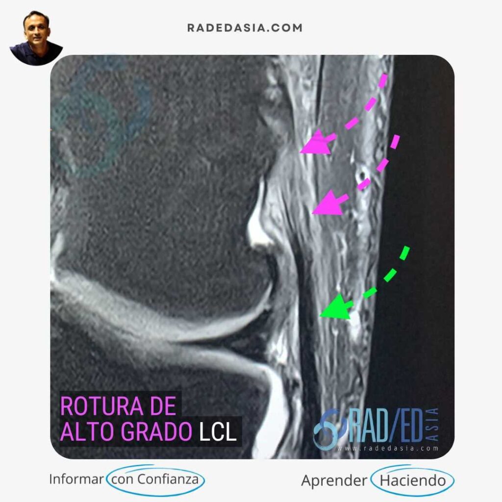 Resonancia magnética coronal PDFS de la rodilla que demuestra una rotura de alto grado del ligamento colateral lateral (LCL) de la rodilla con aumento de la señal e interrupción de las fibras. Observe la comparación con el LCL distal normal
