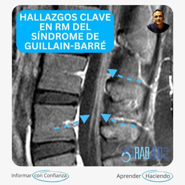 síndrome de guillain-barre-mri-hallazgos-mejora nerviosa-espina-radiología-radedasia