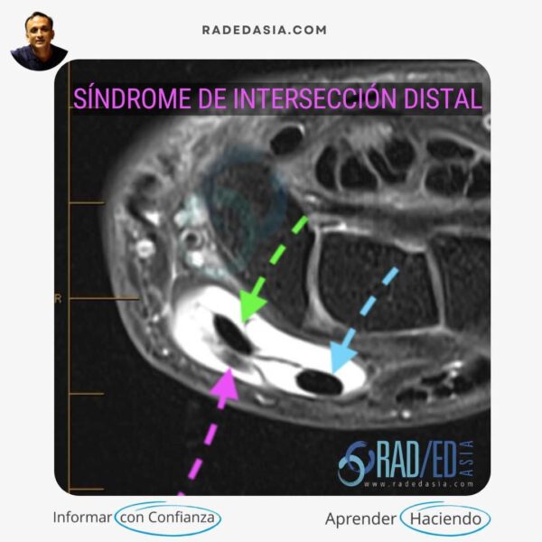 Resonancia magnética de la muñeca que muestra un síndrome de intersección distal con tenosinovitis distal al tubérculo de Lister, demostrando una tenosinovitis significativa que afecta a los tendones de los compartimentos 2 y 3.