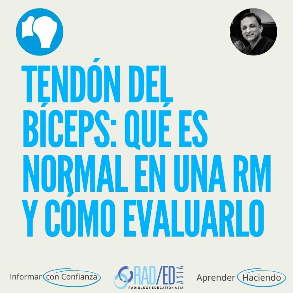 RMN de hombro Tendón del bíceps RMN normal y cómo evaluarlo.