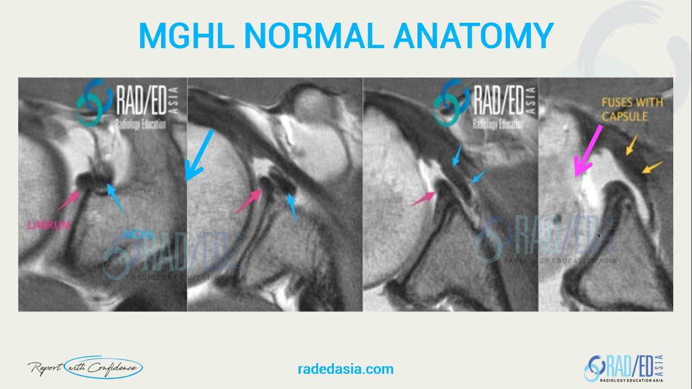 Axial MRI series demonstrating normal anatomy of the middle glenohumeral ligament (MGHL), labrum, and capsule.