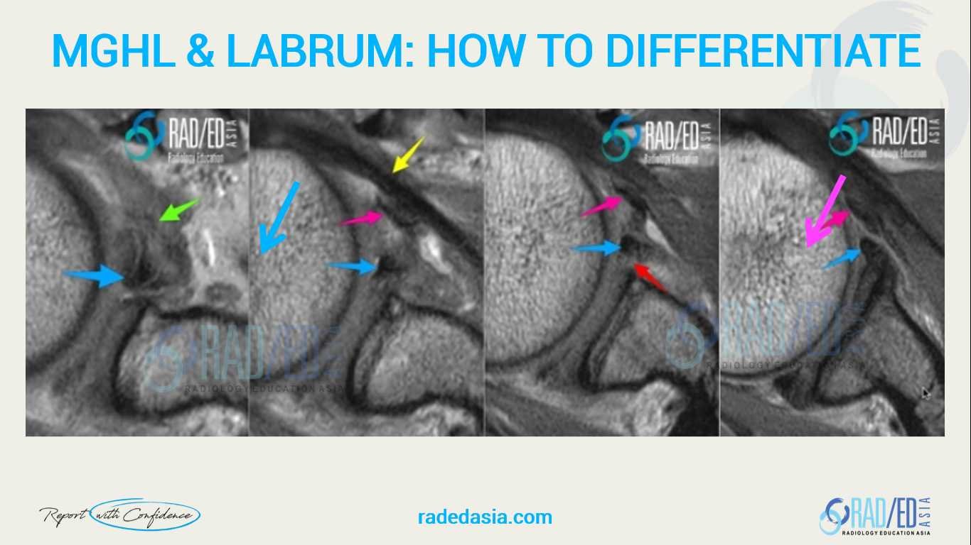 Axial MRI series showing clinical differentiation between the middle glenohumeral ligament (MGHL) and the anterior labrum.