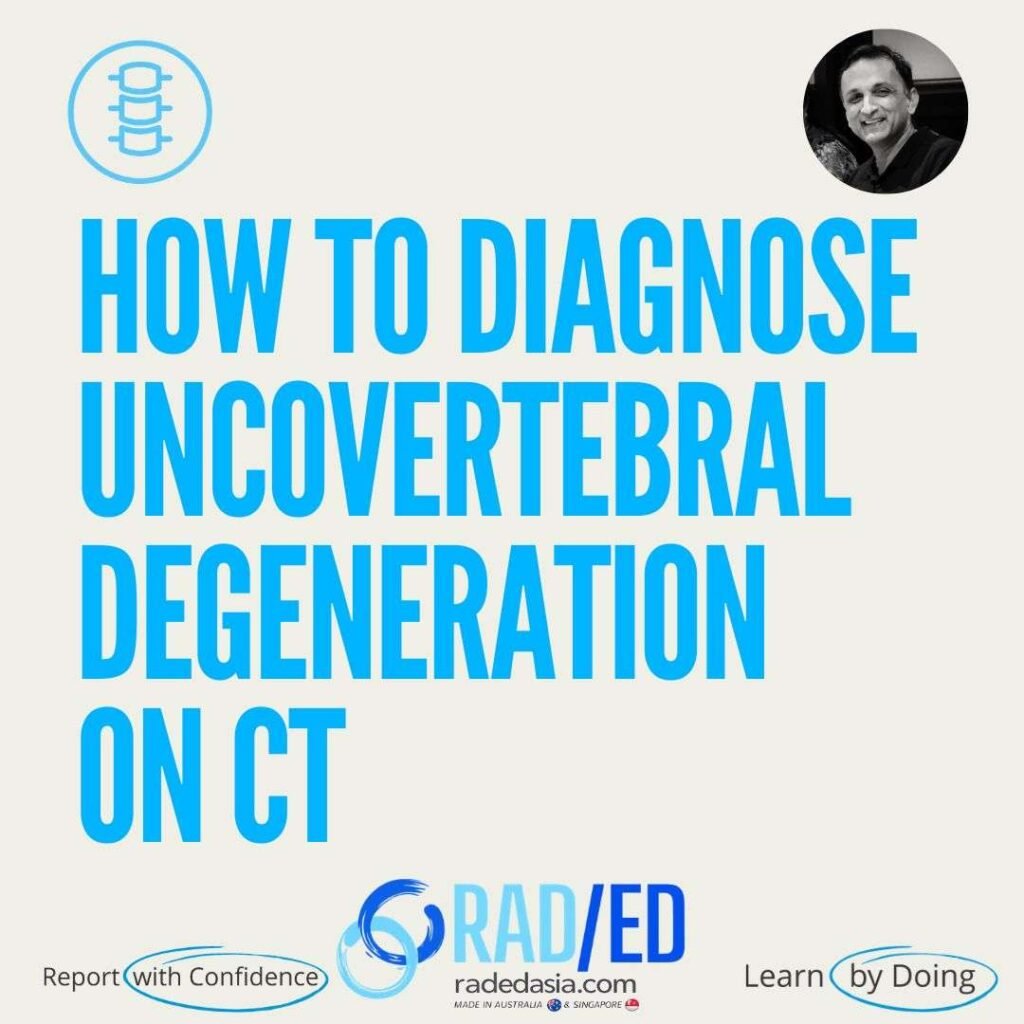 How to diagnose uncovertebral joint (uncinate process) degeneration on cervical spine CT — coronal findings, sclerosis, and foraminal nerve root compression.
