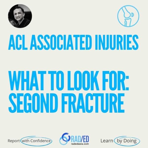MRI evaluation of ACL-associated second fractures, highlighting key secondary osseous injuries associated with anterior cruciate ligament tears.